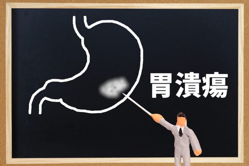 胃潰瘍で吐血した場合の対処方法とは?吐き気やみぞおちの痛みを伴う原因も解説 - 外科DOC - 日帰り手術の名医を中心に掲載
